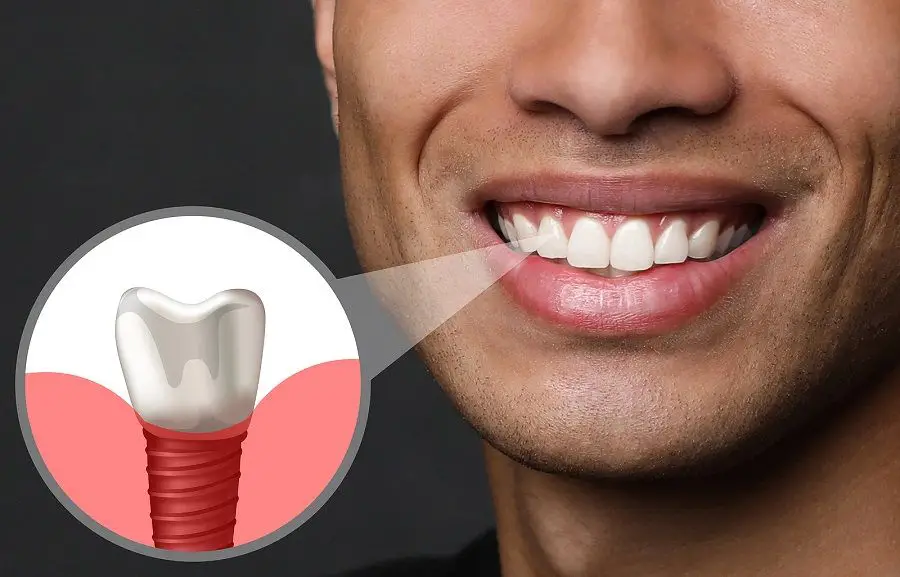 Everything You Need To Know About Dental Implants