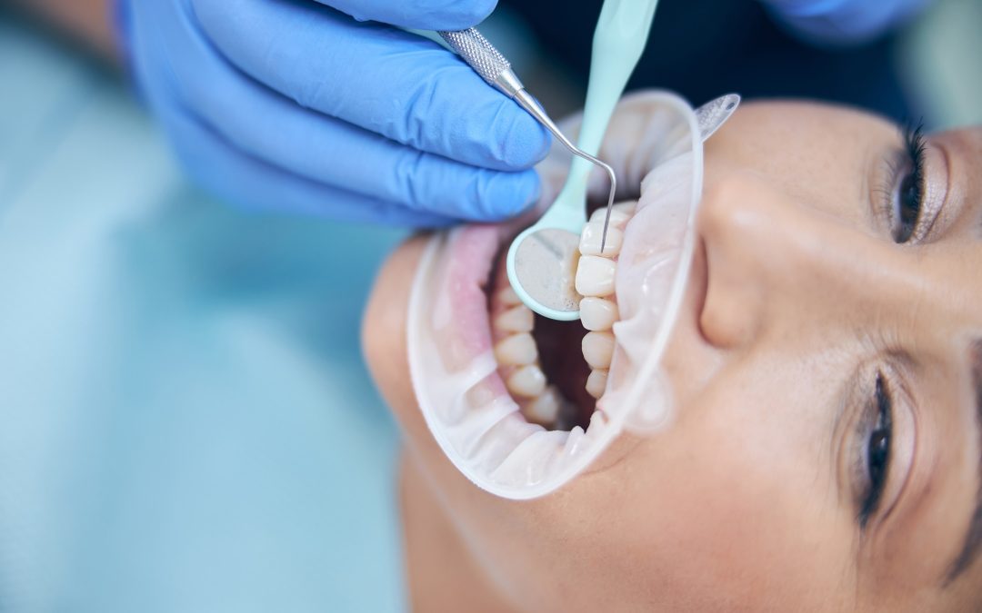 Professional Teeth Whitening vs. DIY Kits in Prairieville, LA